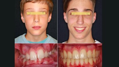 ¿Extracción o Expansión en Ortodoncia? (1)