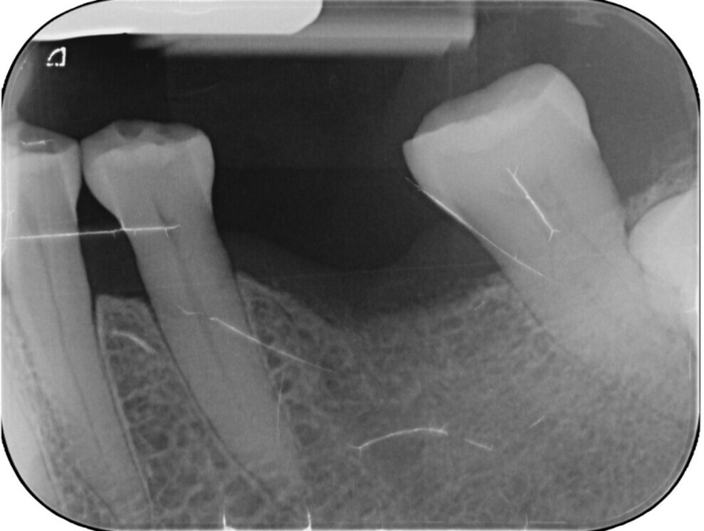 Fig. 1: Radiograph of the single edentulous site in the region of tooth #36 requiring restoration.