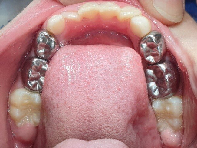 Afbeelding 5b: Kleurfoto’s op de leeftijd van 7 jaar, juli 2019. Alle cariëslaesies in de bovenkaak zijn arrested, hard en glanzend, goed bereikbaar voor het poetsen. De mondhygiëne is goed. De eerste blijvende molaren breken door.