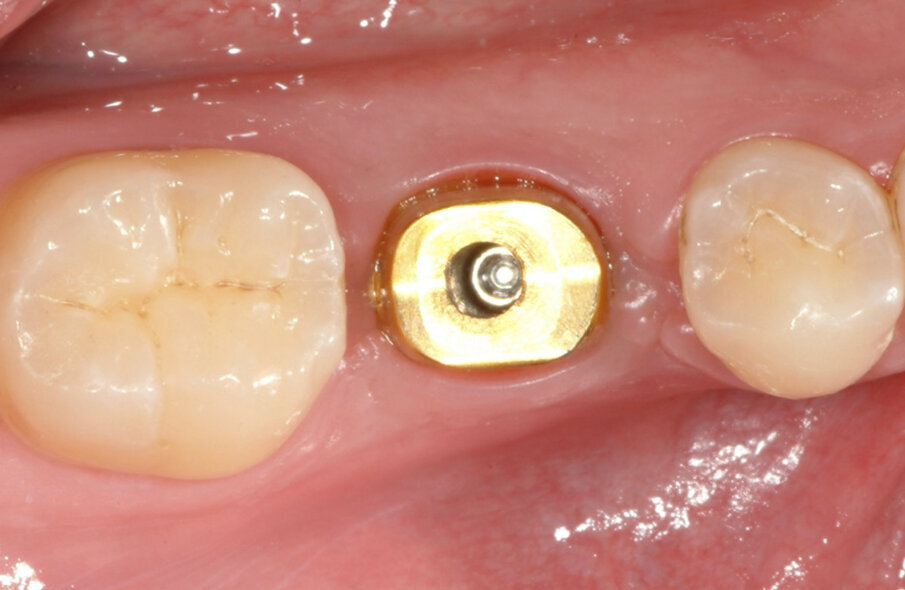 Fig. 14: The
Atlantis abutment was placed with some pressure on the soft tissue. After a few
minutes, the ischaemia disappeared, and the abutment was seated in the correct position.
