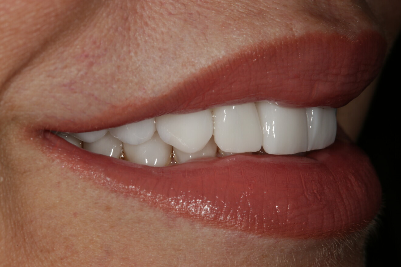Fig. 22: Post-op right lateral view of the patient’s completed smile. Comparison with Figure 18 shows how nicely the denitive restorations followed the approved PMMA restorations.