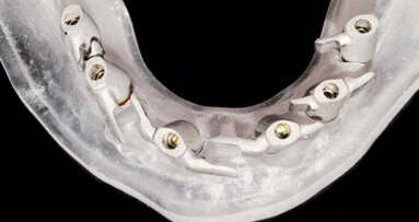 Dělený třmen jako výztuž provizorní náhrady