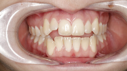 Hybrid sagittal decompression to optimise aligner efficiency in an anterior open bite case