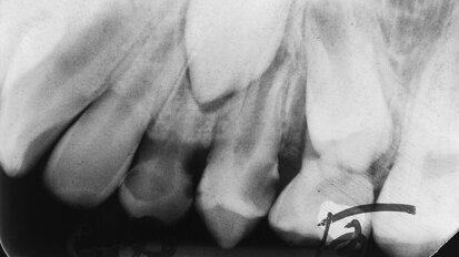 Success evaluation of N2 treated teeth with open apical foramen—A retrospective study