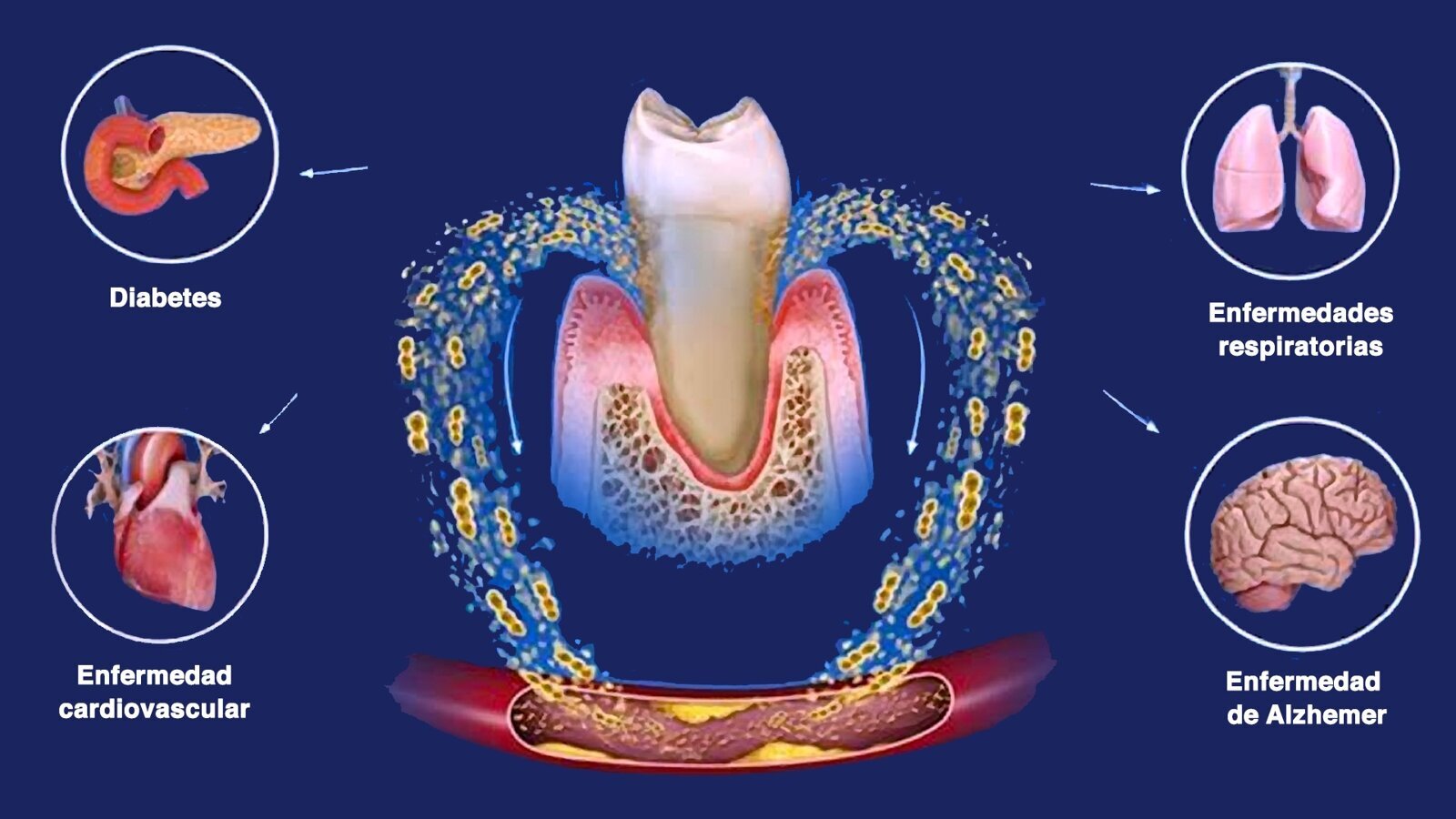 De las encías al cerebro: la conexión oculta entre Alzheimer y Periodontitis