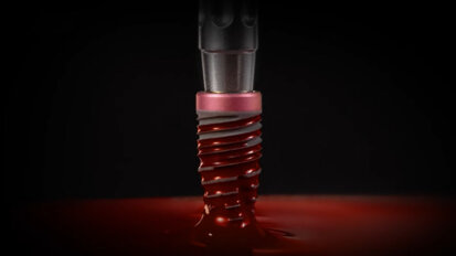 Keystone Dental Group – Genesis BioSpark Hydrophilic Surface