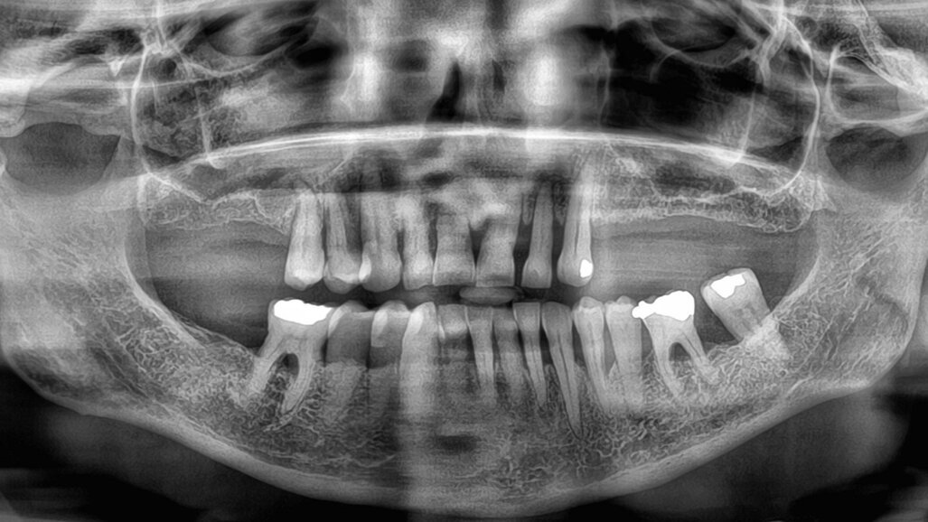 Immediate loading of the posterior maxilla with two abutment-level bridges produced in a digital workflow
