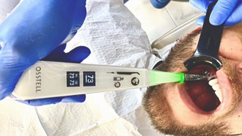 ¿Cómo predecir el éxito de los implantes?