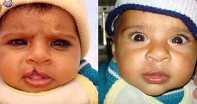 Chinese Doctors to Perform Free Cleft Lip and Palate Operations