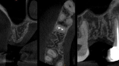 Preservazione della cresta ossea mediante tecnica di Inibizione Periostale Modificata: un caso pilota