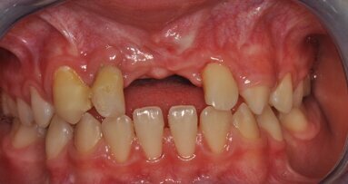 Autotransplantacja jako metoda autogennej rekonstrukcji ubytków wyrostka zębodołowego