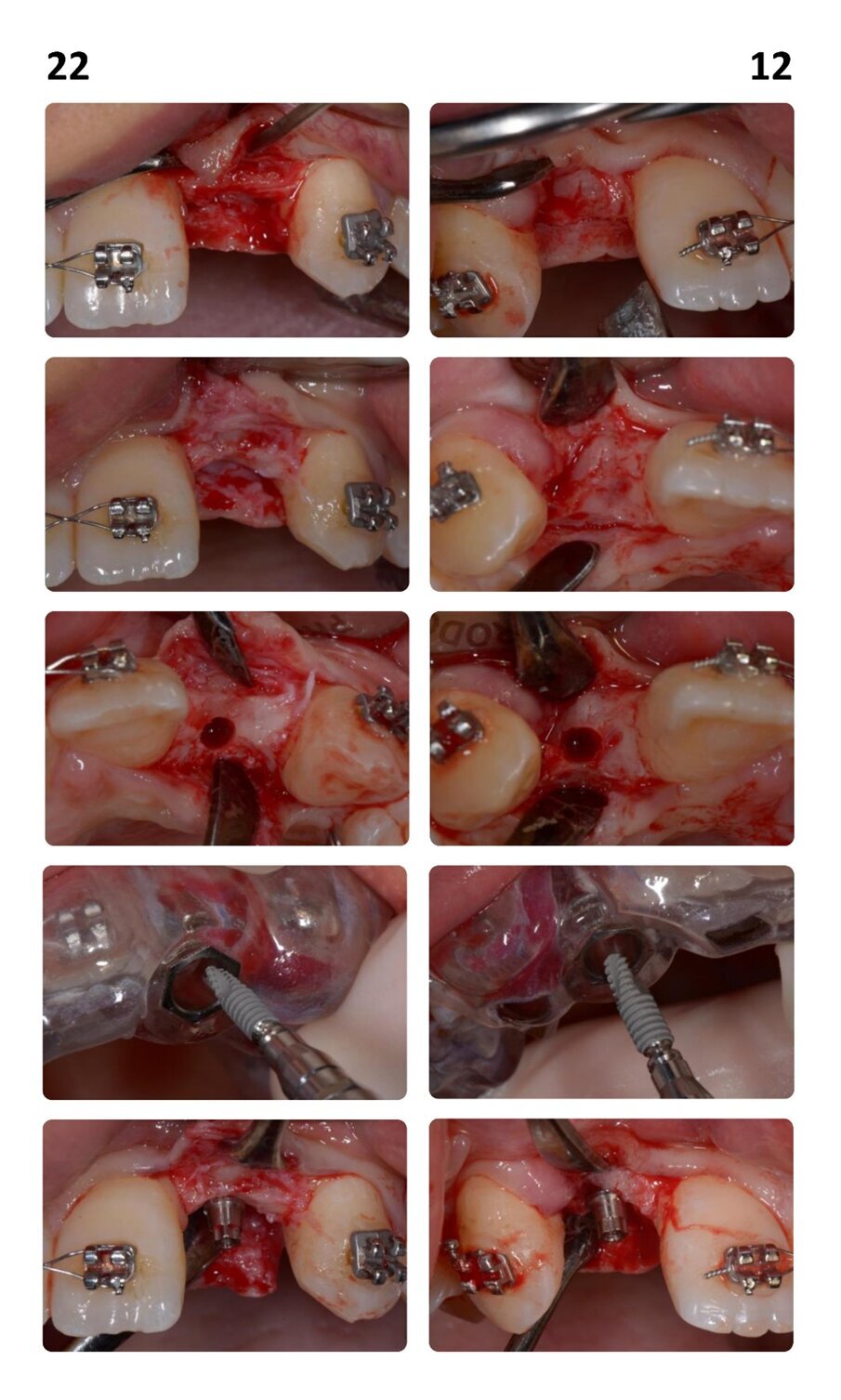 Fig. 4_Procedimento chirurgico finalizzato all’inserimento degli impianti B1ONE HIGH in posizione 22 (2,7 x 12 mm) e 12 (3,2 x 12 mm) mediante chirurgia guidata. Al termine dell’inserimento, è visibile la connessione intracoronale dell’impianto monopezzo.