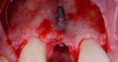 GBR in area estetica: gestione di un caso clinico dalle fasi chirurgiche a quelle protesiche