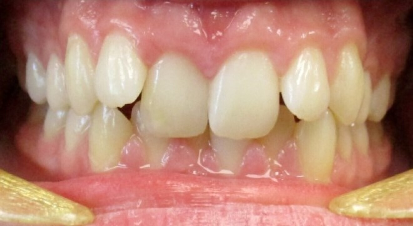 Fig. 9: Crowding and deep bite in a 17-year-old male patient.