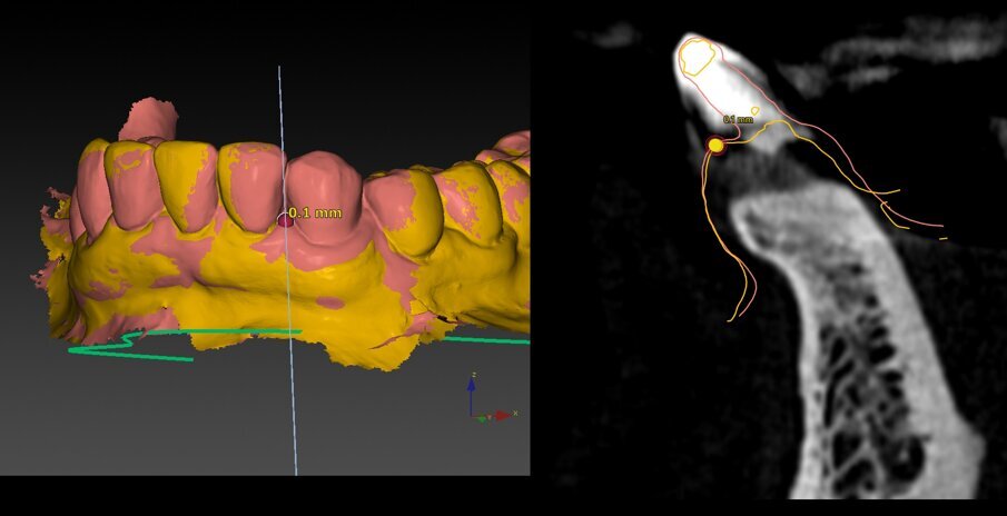 Figg. 22, 23_Matching degli STL pre e post per la valutazione delle modifiche a livello delle papille. La mesiale risulta mantenuta, mentre la distale subisce una piccola perdita pari a 0,8 mm.