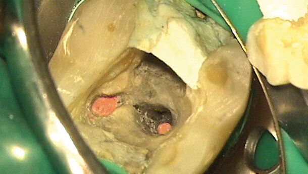 Résultats du sondage sur les systèmes d'obturation canalaire à chaud