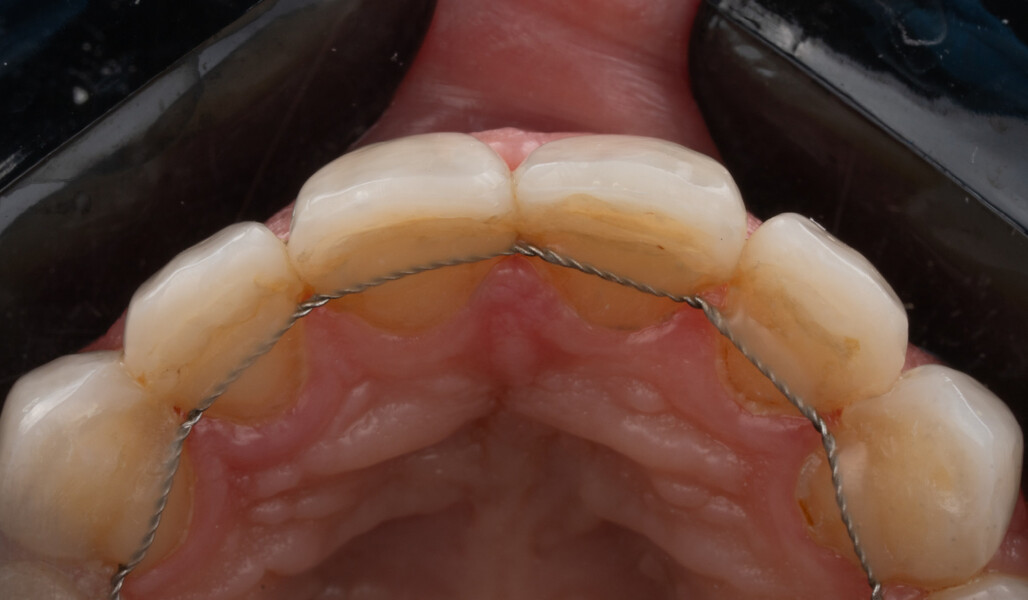 Fig. 9b: Final treatment outcome. Intra-oral occlusal view.