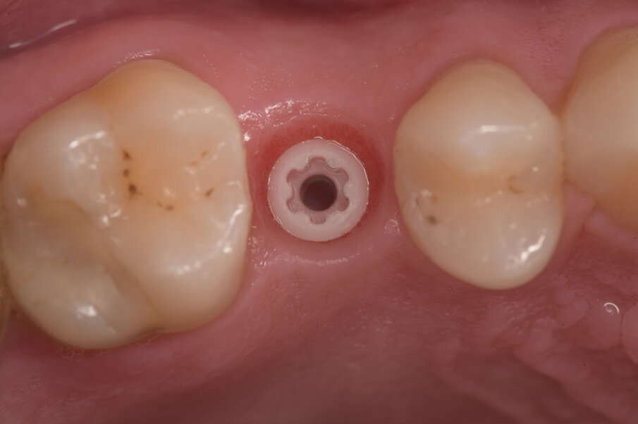 Fig. 5 - A distanza di 30 giorni dal carico funzionale con la corona provvisoria si valuta il condizionamento tissutale e la guarigione ossea.