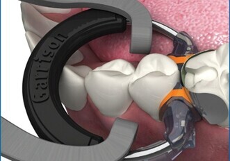 Tight contacts with new separator ring Tight contacts with new separator ring