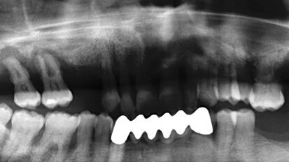 Postupy vertikální kostní augmentace