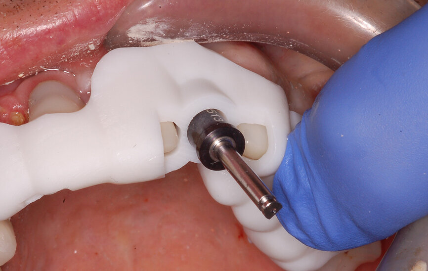 Fig. 8a: Using drill guides with long shanks to engage the sleeveless template allowed for sequential and accurate drilling of the tooth and subsequent bone for implant placement.