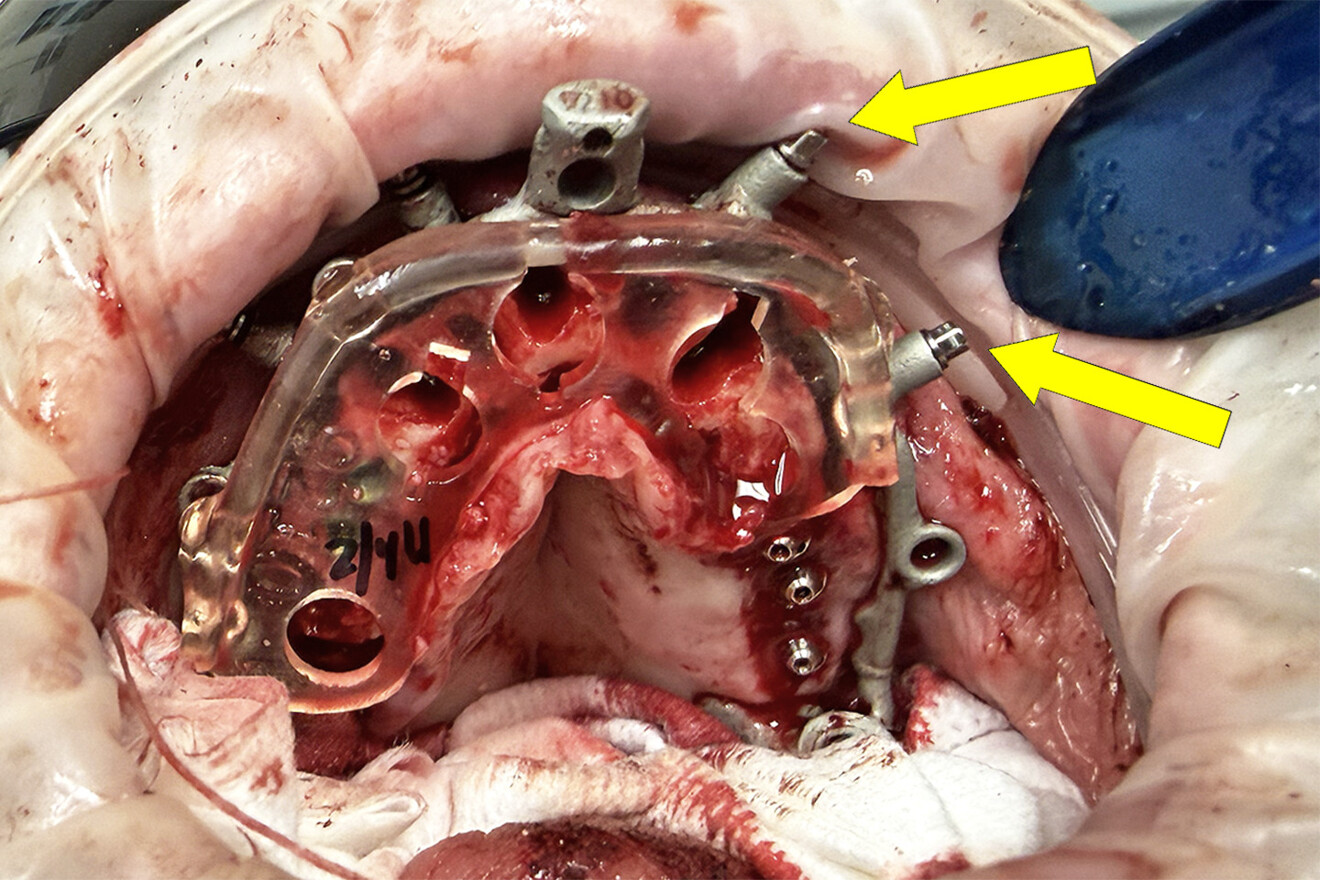 Fig. 17: Retracted intra-oral view after tooth extraction and bone reduction, showing the base frame secured to the maxillary bone with the anchor pins (yellow arrows) and the bone reduction and timing jig attached to the frame.