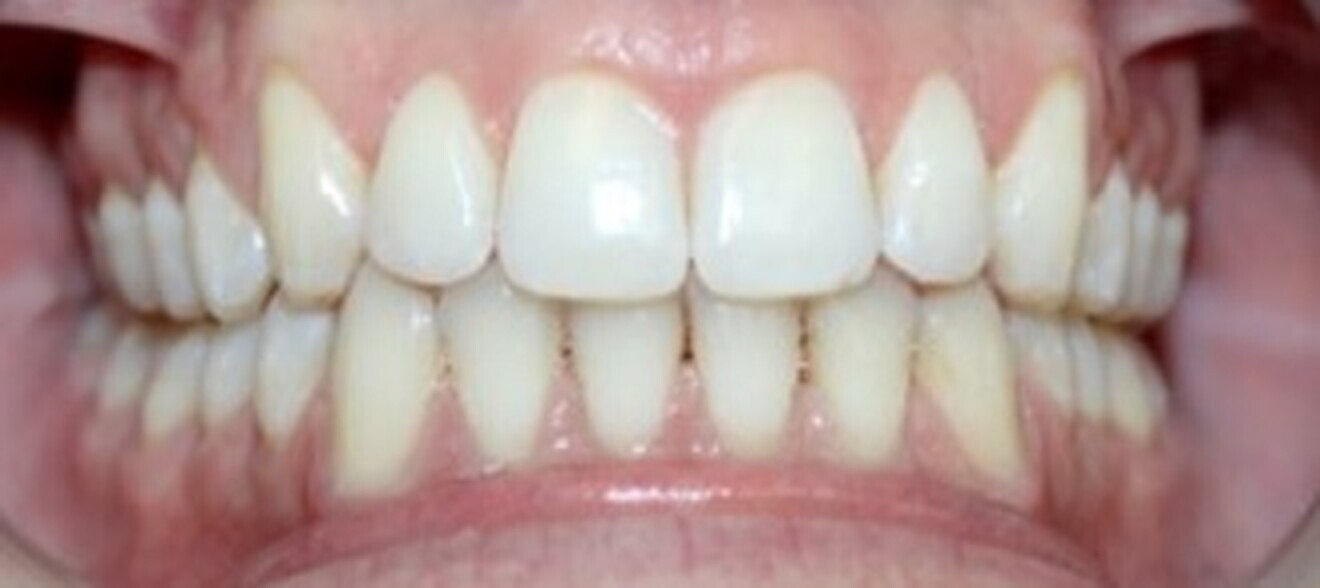 Fig. 5: Movement achieved after nine months.