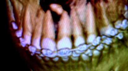 Cone beam CT-based imaging for evaluation of supernumeraries