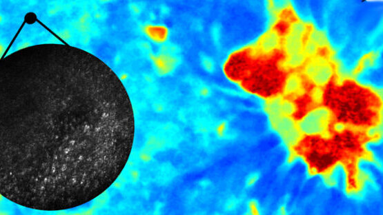 Pesquisadores rumo ao avanço no diagnóstico do câncer bucal