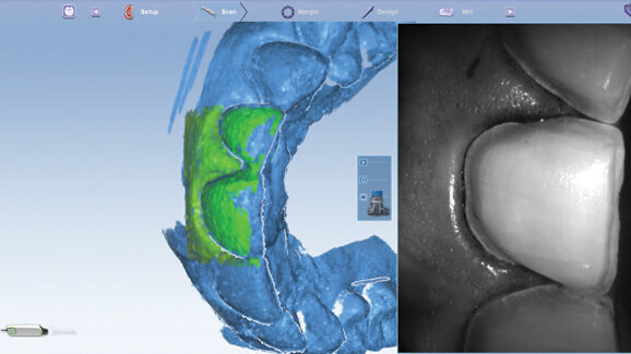 Click here! Digital impression margination made easy