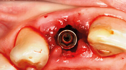 Impianto post-estrattivo in zona estetica. Le chiavi per un successo predicibile e stabile nel tempo