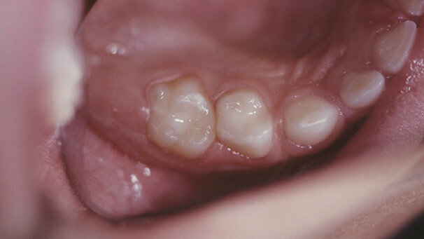 Irruvidire, pulire e preparare: le sabbiatrici nello studio dentistico sono una vera “bomba” per i pazienti