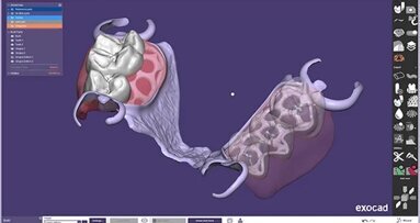 Exocad, PartialCad 3.1 Rijeka’nın Yeni Sürümünü Piyasaya Sürdü