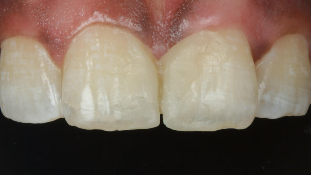 Fig 5. Quick intra-oral mock up was performed without etching or bonding. Care was taken to divide the space equally between the two central incisors and the same was confirmed by measuring with vernier calliper. This can also be done with the chosen shades of composite to roughly evaluate the selected shade.  It is also recommended to check occlusion at this point and remove any static/dynamic interferences.