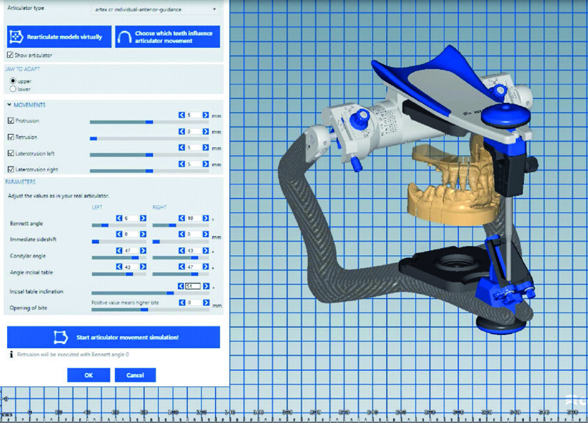 Fig. 4b : Les données du système CADIAX ont été transférées  dans l’articulateur virtuel.