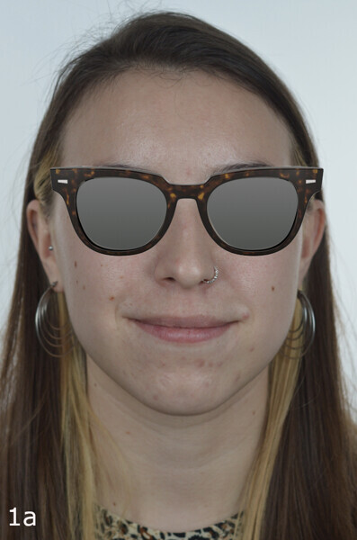 Figs. 1a–3b: Dolichofacial 23-year-old female patient with a vertical skeletal Class III malocclusion and increased lower face height.