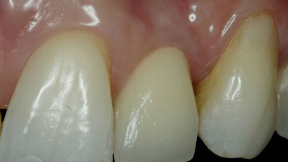 New grafting procedure for oral implantation