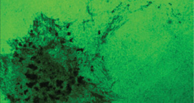 Neutrophil and cancer cell ‘crosstalk’ underlies oral cancer metastasis