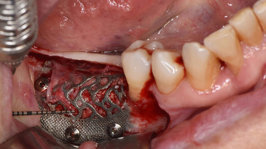 Figg. 9a-9c_Foto intra-operatoria durante la rimozione della griglia in titanio che evidenzia l’incremento osseo ottenuto e l’assenza di perdita ossea al di sotto della griglia.