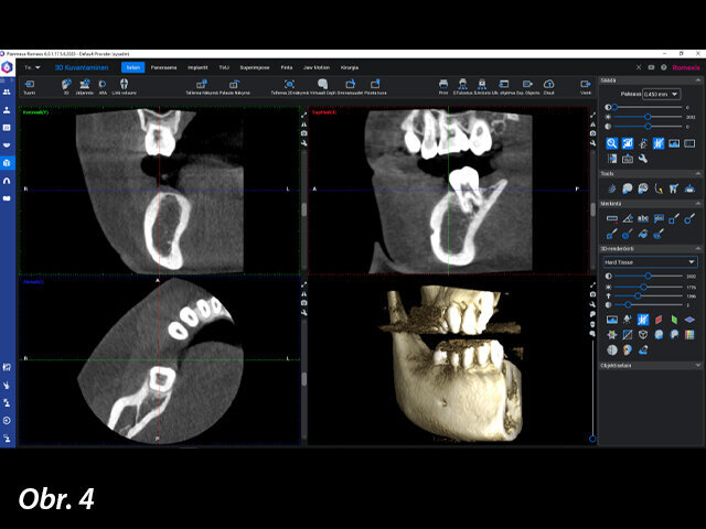 3D snímek postižené oblasti byl pořízen pomocí rentgenu Planmeca Viso G7.