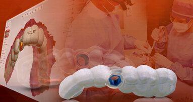Glidewell now offering digital treatment planning to implant dentists
