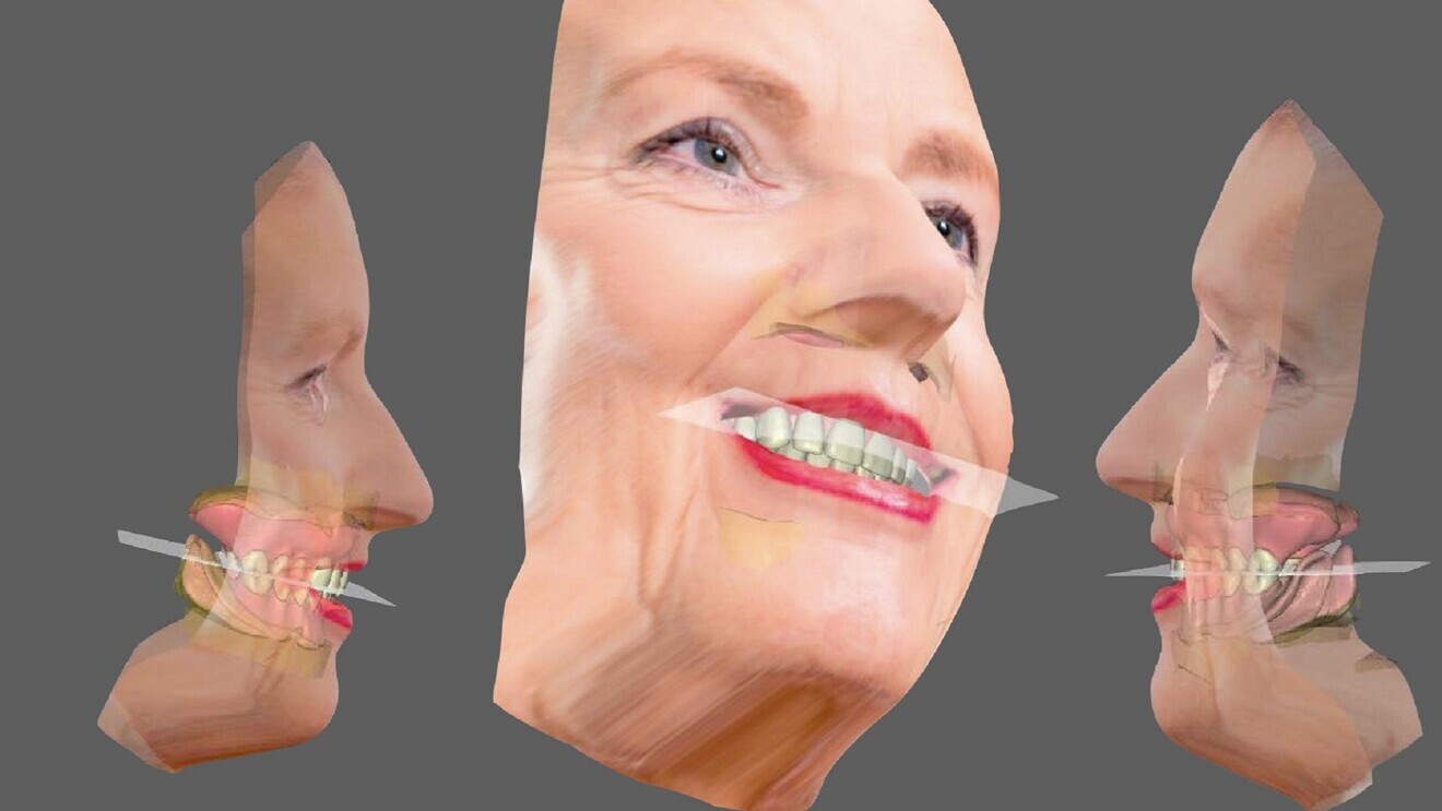 Fig. 11: Complete prosthetic simulation.