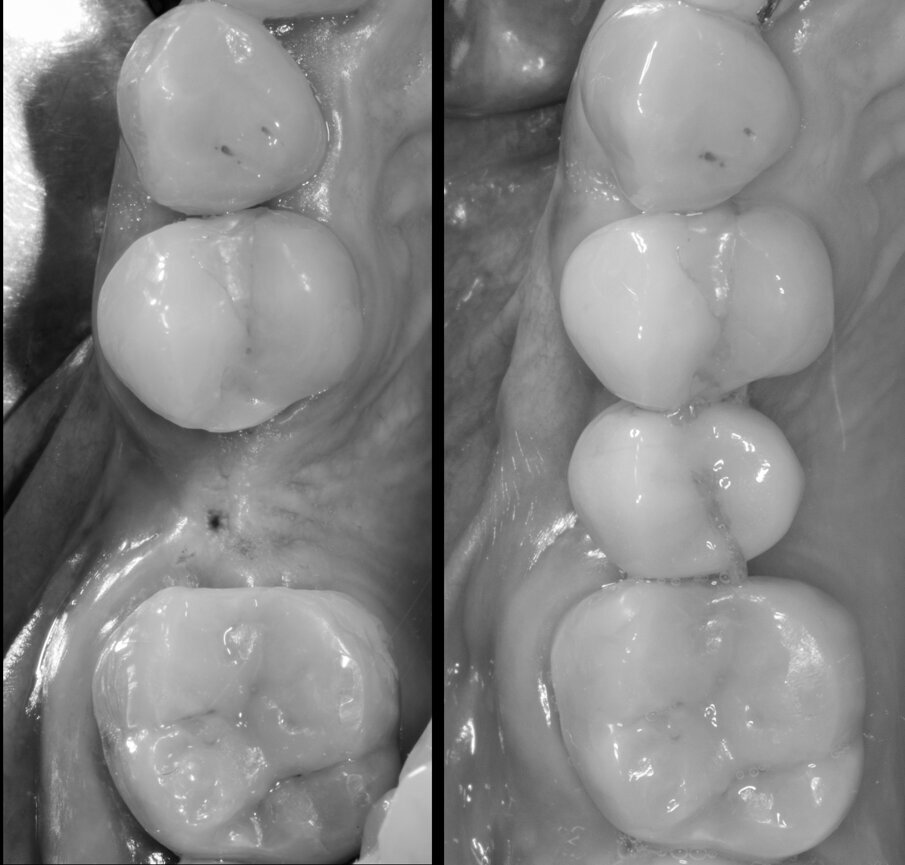 Fig. 31 - Confronto tra baseline e 6 anni da riabilitazione implanto protesica.