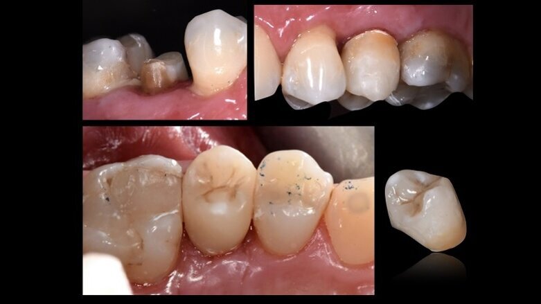 Un innovador poste radicular ayuda a preservar la sustancia dental