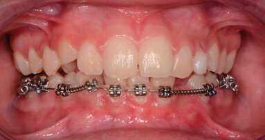 Il tailor-made del controllo del biofilm batterico. Nel paziente in trattamento ortodontico: case report