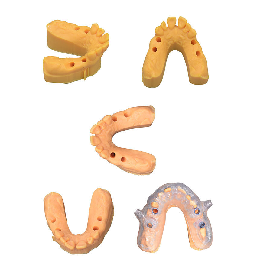 Fig. 41_Il modello chirurgico è una guida limitativa che dirige il processo di perforazione e il successivo posizionamento dell’impianto offrendo un notevole vantaggio al chirurgo, migliorando la precisione e riducendo al minimo le complicazioni come danni ai nervi mandibolari, perforazione sinusale, fenestrazioni e deiscenze.
