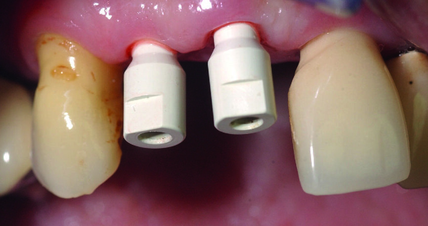  Figs. 11a & b : Vues cliniques et occlusales des scan bodies en place. Notez les positions et les axes obtenus, qui faciliteront les réalisations prothétiques définitives. 