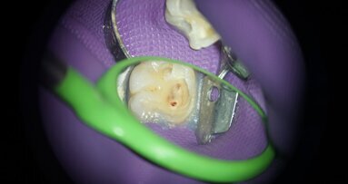 גורמים המשפיעים על ההחלטה לבצע כיפוי מוך ישיר