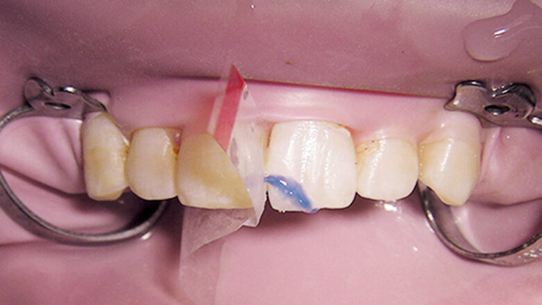 Léčba traumat zubů – doporučené postupy