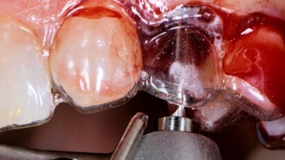 Alternatywne leczenie implantoprotetyczne przy wrodzonej hipodoncji siekaczy